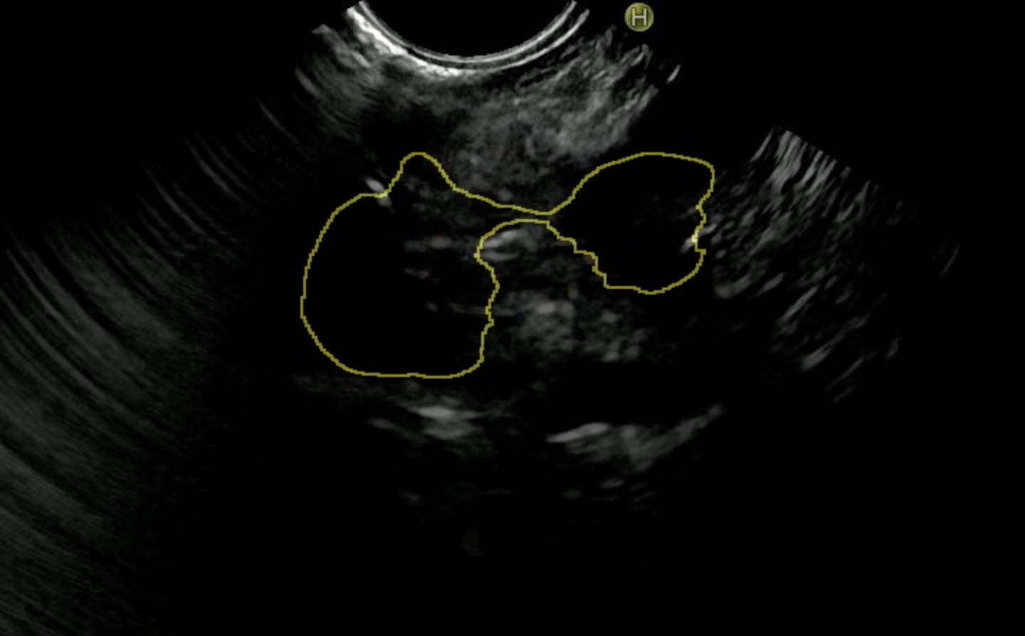 AI Endoscopic Analysis Detection